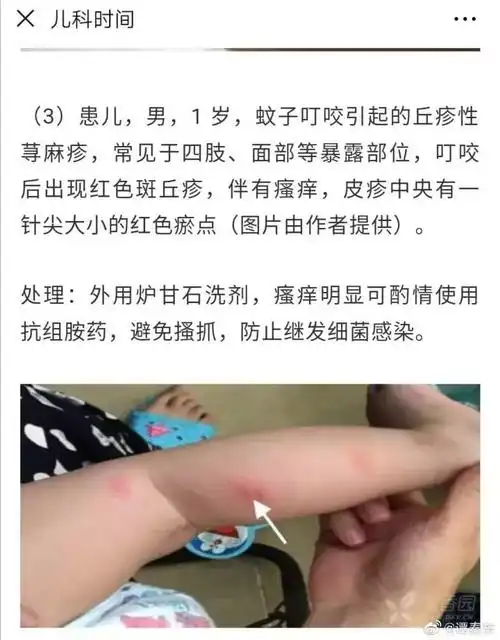小公主遇上虫咬性皮炎我们这样处理的