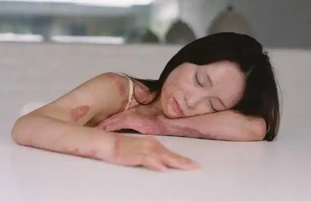 被富二代同学泼汽油烧伤的女孩拍写真 获网友大赞