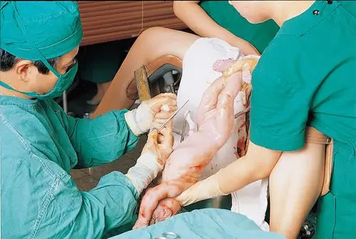 女人孕妇生孩子分娩过程_有来医生