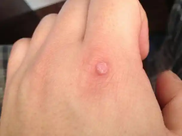 小心脸上手上的凸疣,有什么治猴子的简单又实用的妙方?