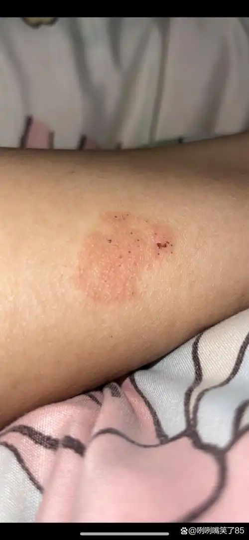 这个在小腿后面长的 很痒 到底是啥