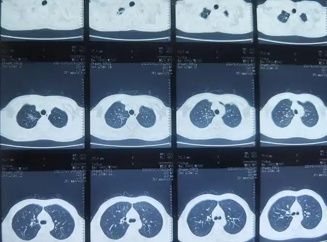 2020年10月ct:右肺上叶少量纤维灶,未显示明确胸膜黏连,增厚征象