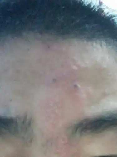 额头上突然起了这样的米粒和黑头的小痘痘,也有点疼