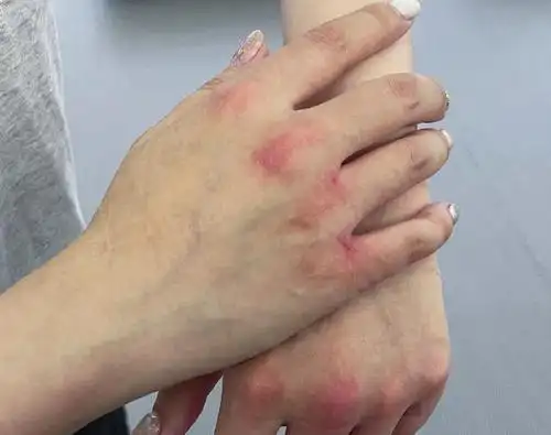 女演员晒手受伤照片配文非常幽默