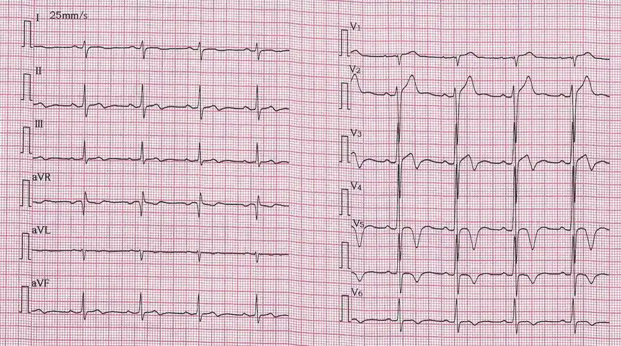 临床实用心电图入门 第十二讲 t波改变与心肌缺血
