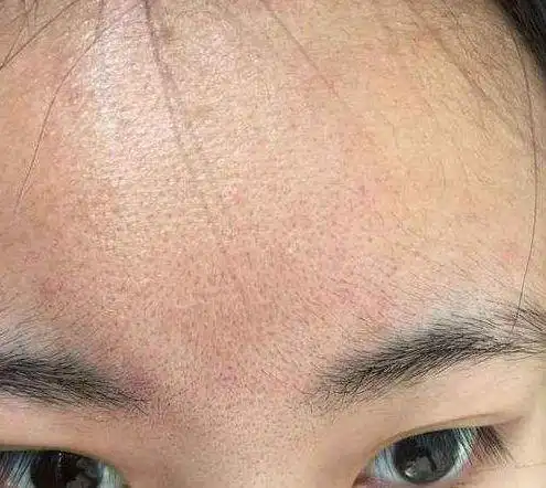 面部毛孔堵塞怎么疏通 各种皮肤类型的疏通小技巧