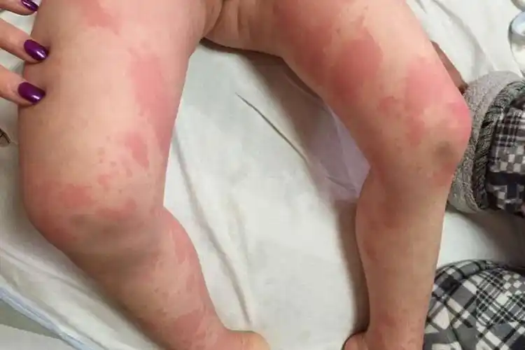 大腿过敏图片_有来医生