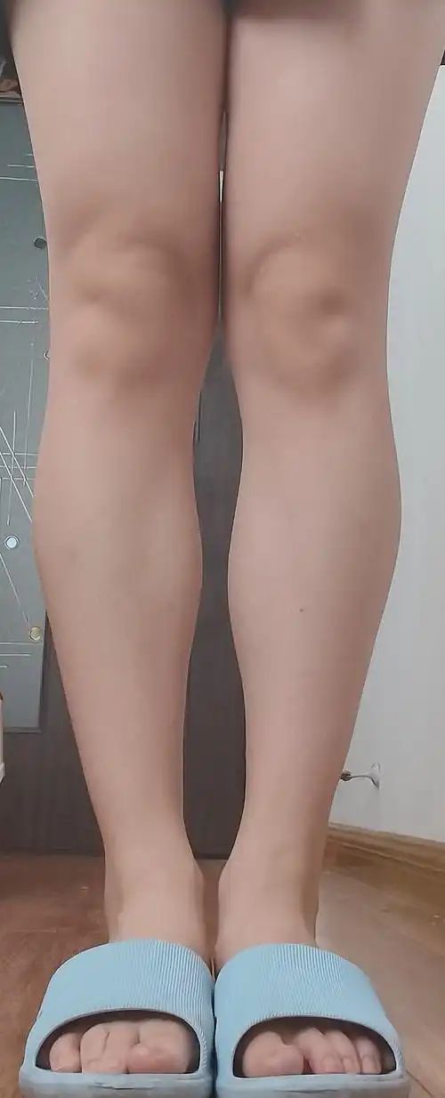 157,小腿围32,这个小腿肌肉形态也太丑了,内侧肌肉鼓起来一大块,平时