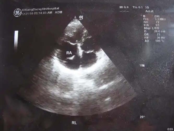 大家看个心脏彩超