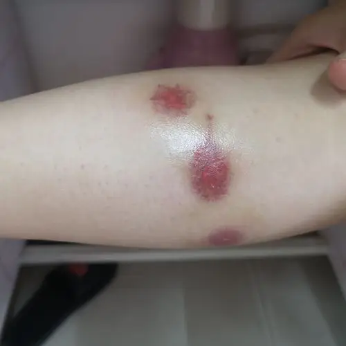 被毒蚊子咬后如何快速消肿止痒