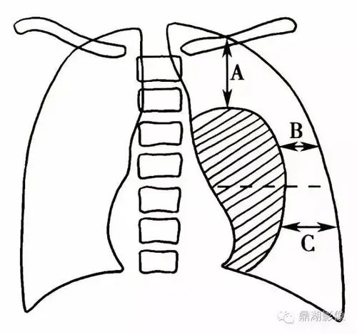 气胸测量的影像学方法