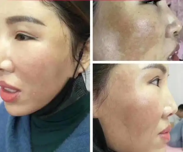 班豆管家丽容素祛斑祛痘套盒厂家