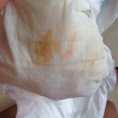 四个月的男宝宝这两天尿包尿有红褐色的东西,这是怎麼回事