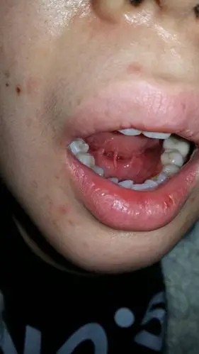 舌头下面起了两排对称的肉面 还有两个白色尖的肉粒 不痛不痒 这是