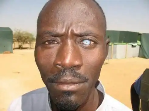 情况严重,建议及时就医,做检查,配合医生治疗,避免情况加剧导致失明