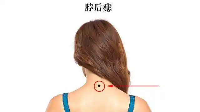 脖子长痣对运势有何影响,象征屋下藏金的苦情痣,你有吗?