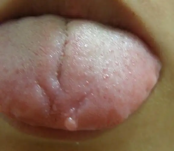 舌头上长了个疙瘩,请问是怎么回事?要不要去医院切掉?挂什么科?