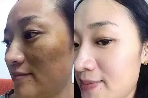 超皮秒祛斑创伤大吗?