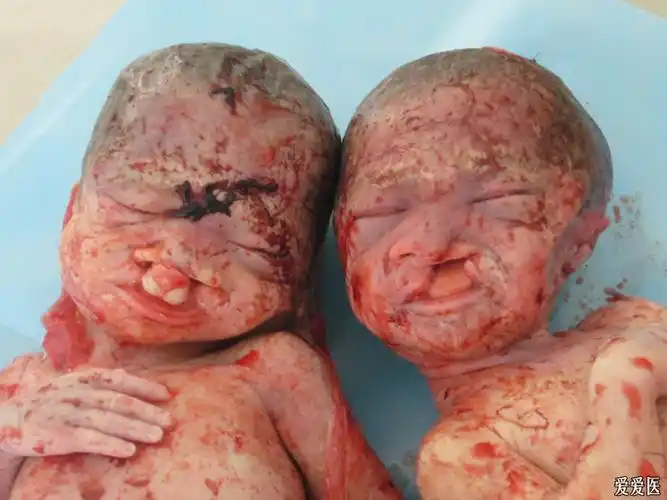 双胎唇裂合并腭裂