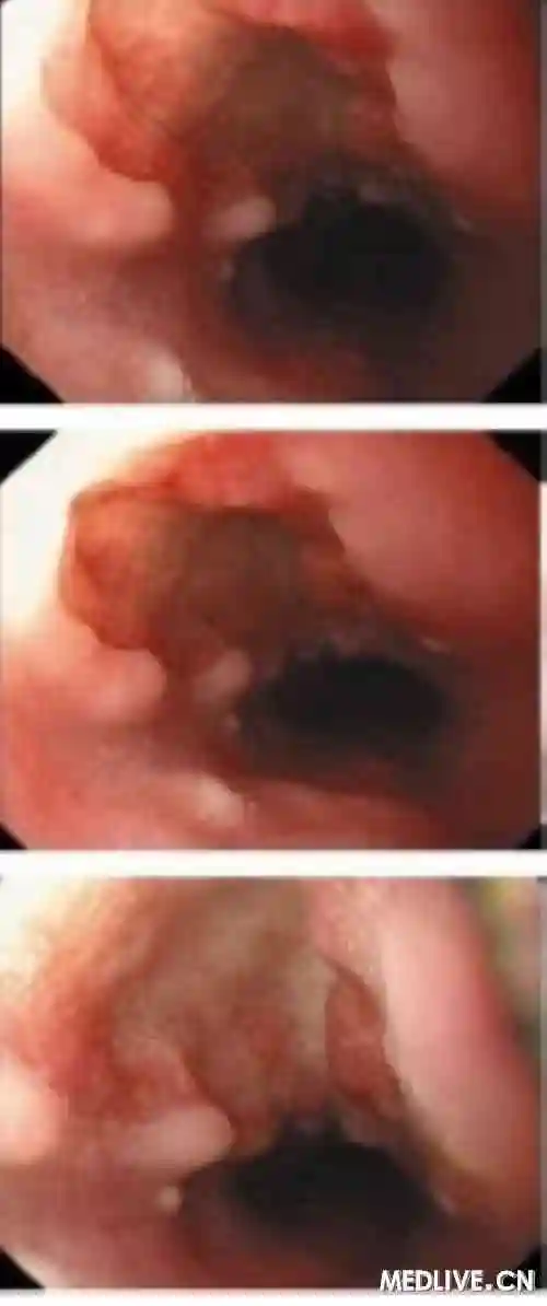 尖锐图片湿疣图片_女性尖锐湿疣_尖锐性湿疣女性