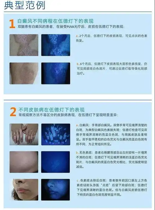 亲们身上白斑是什么伍德灯为您快速揭晓