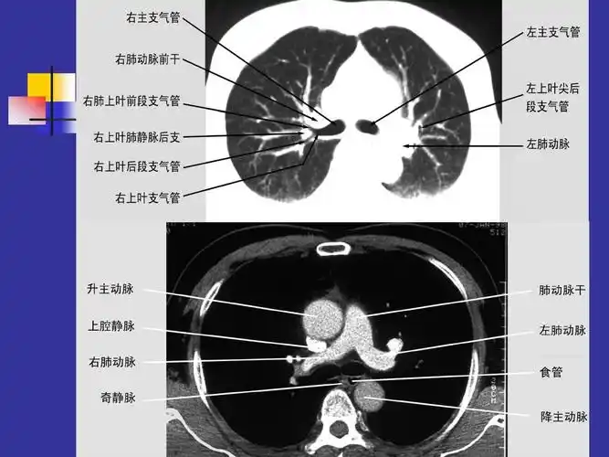 胸部ct课件之正常表现ppt
