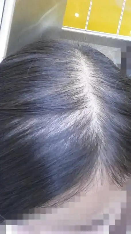 女生23岁头顶头发稀疏怎么办有图?