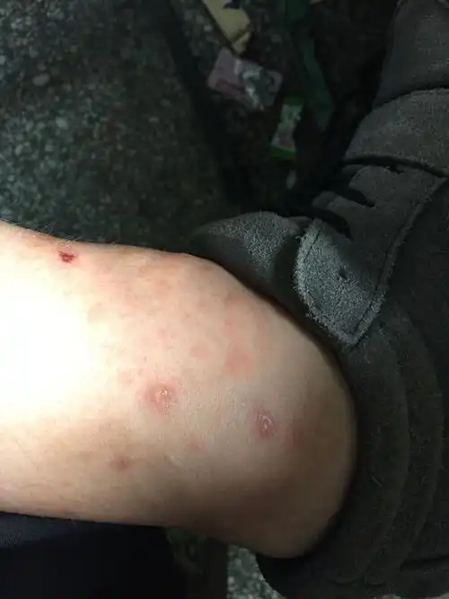 狗狗得了真菌皮肤病,我脚踝长了很多小疙瘩,是不是传染了