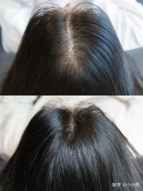 头顶上头发稀疏怎么办?