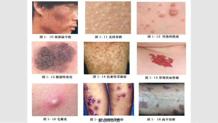 皮肤病的症状体征与诊断2ppt课件