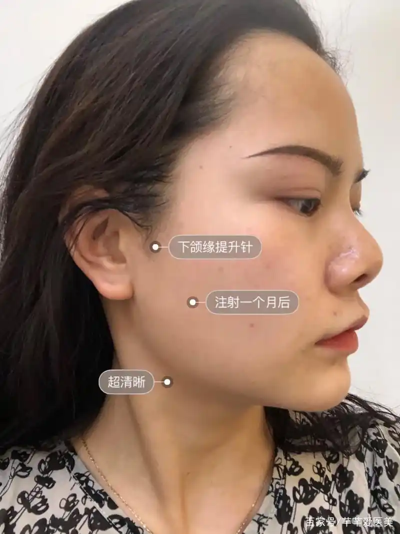 下颌缘提升针注射一个月后效果反馈!