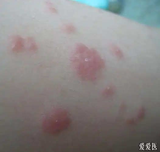 螨虫皮炎治疗前后您来看一看