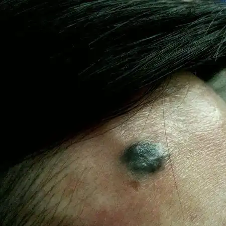 默认排序|按时间排序 4条回答  2 分钟前 医专恢狼|五级 可能是色素痣