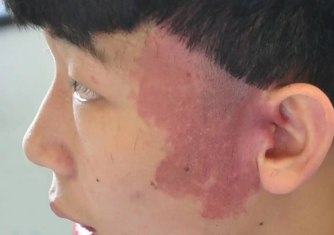 郑州市第二中医院:鲜红斑痣治疗费用