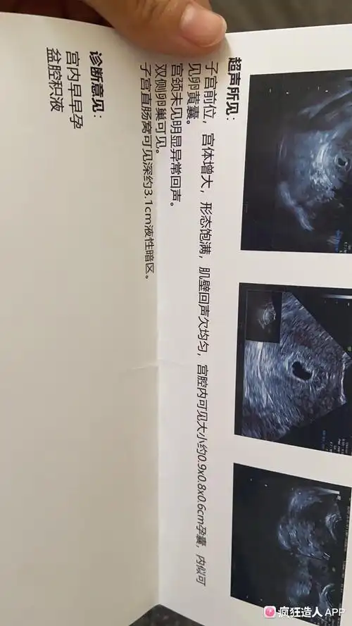 四周孕囊已经来啦!