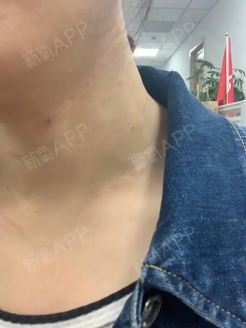 注射的针孔还些红,但是不疼的.