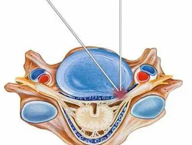 nass:神经根型颈椎病的诊治指南 - 好大夫在线