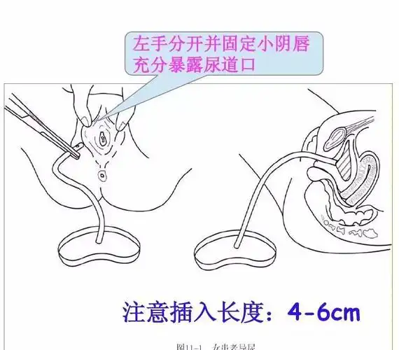4,严格执行无菌技术操作重视医护人员双手的清洁,消毒工作,切断传播