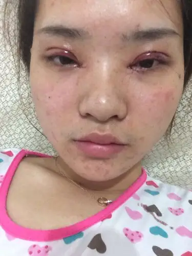 刚割了双眼皮,眼睛好肿,眯不起来,为什么,一直有眼泪