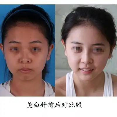 美白针打了真的能白吗?看了你就知道