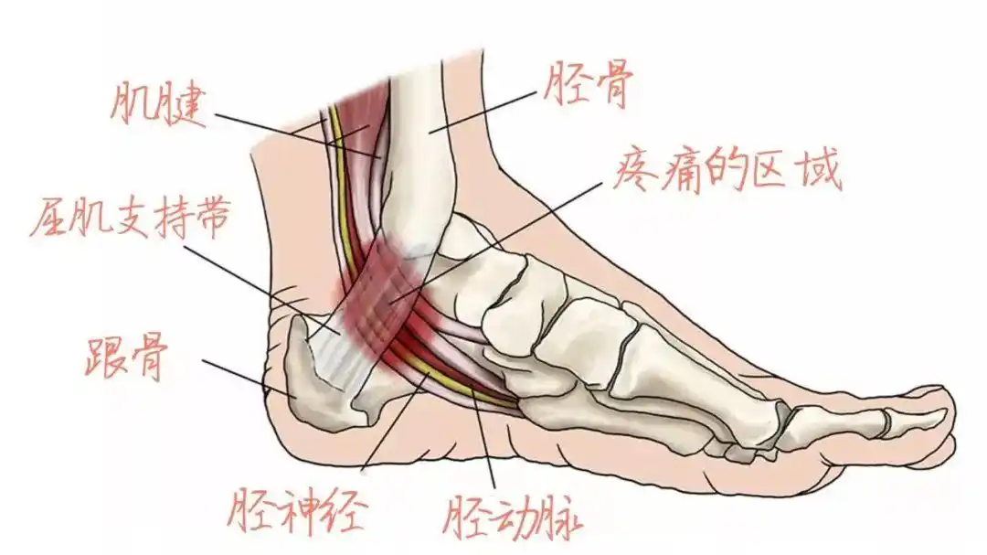 跗管综合征平时"为人低调",且病症容易与足底筋膜炎混淆,所以并不被