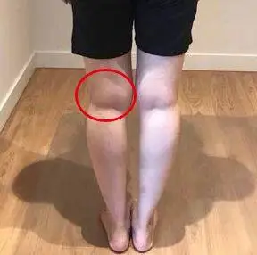 为什么明明不怎么胖,膝盖上还有很多肉? - 那是膝盖长了"双下巴"_时候