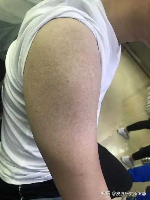 什么是"毛周角化症"什么是"鸡皮肤"? - 知乎