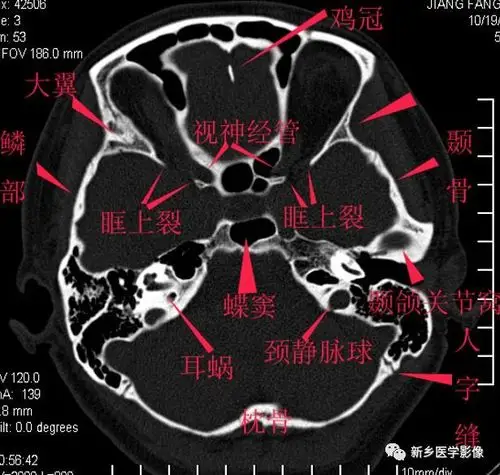 太赞了,纯手工详细标注颅底解剖