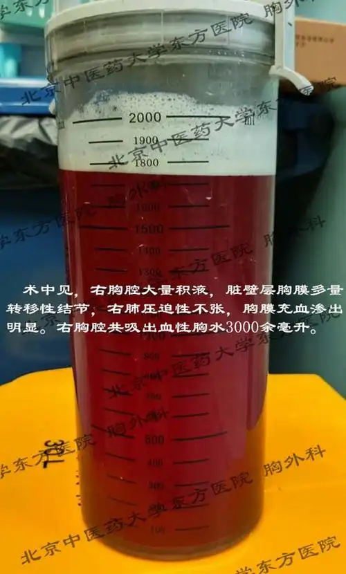 北京中医药大学东方医院胸外科微创治疗顽固性恶性胸腔积液有妙招