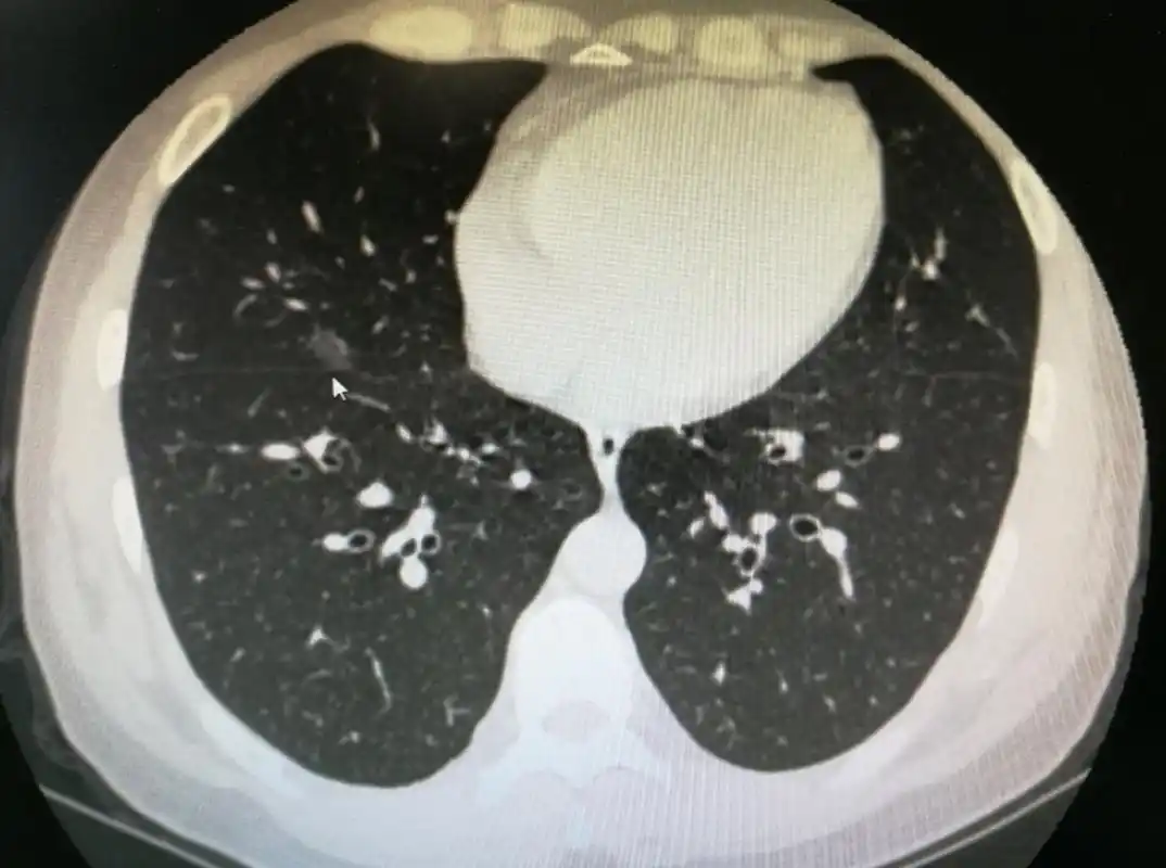 【纤维灶】一般就是结节.  【钙化灶】大多数是良性.