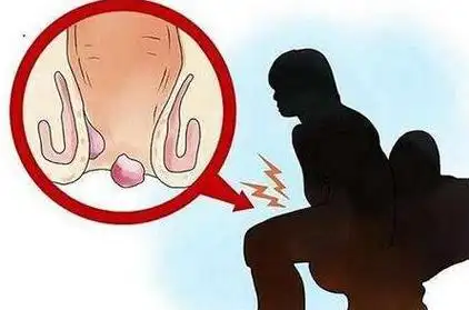 女人痔疮真人实拍图片网上曝光的7个小偏方有效治痔疮图文