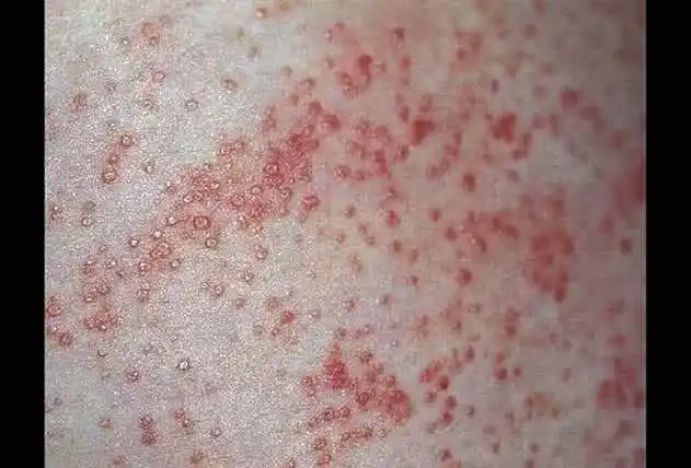 为了不伤害宝宝,一定要分清楚痱子粉与爽身粉