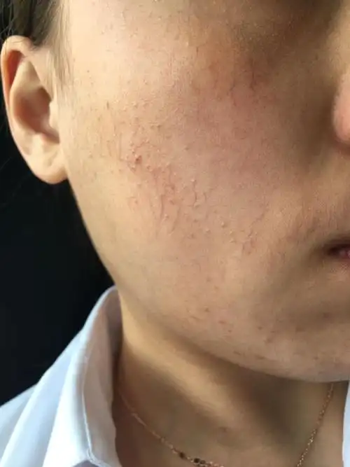 我脸上红血丝有没有办法治