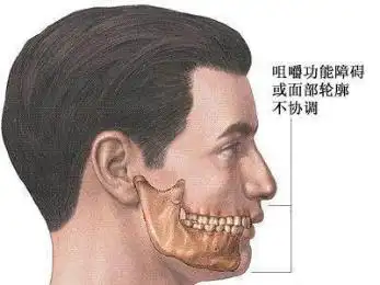 下颌后缩的危害有哪些